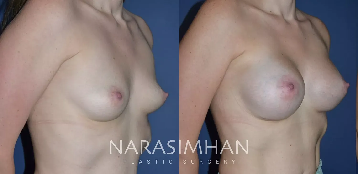 Breast Enhancement Before & After