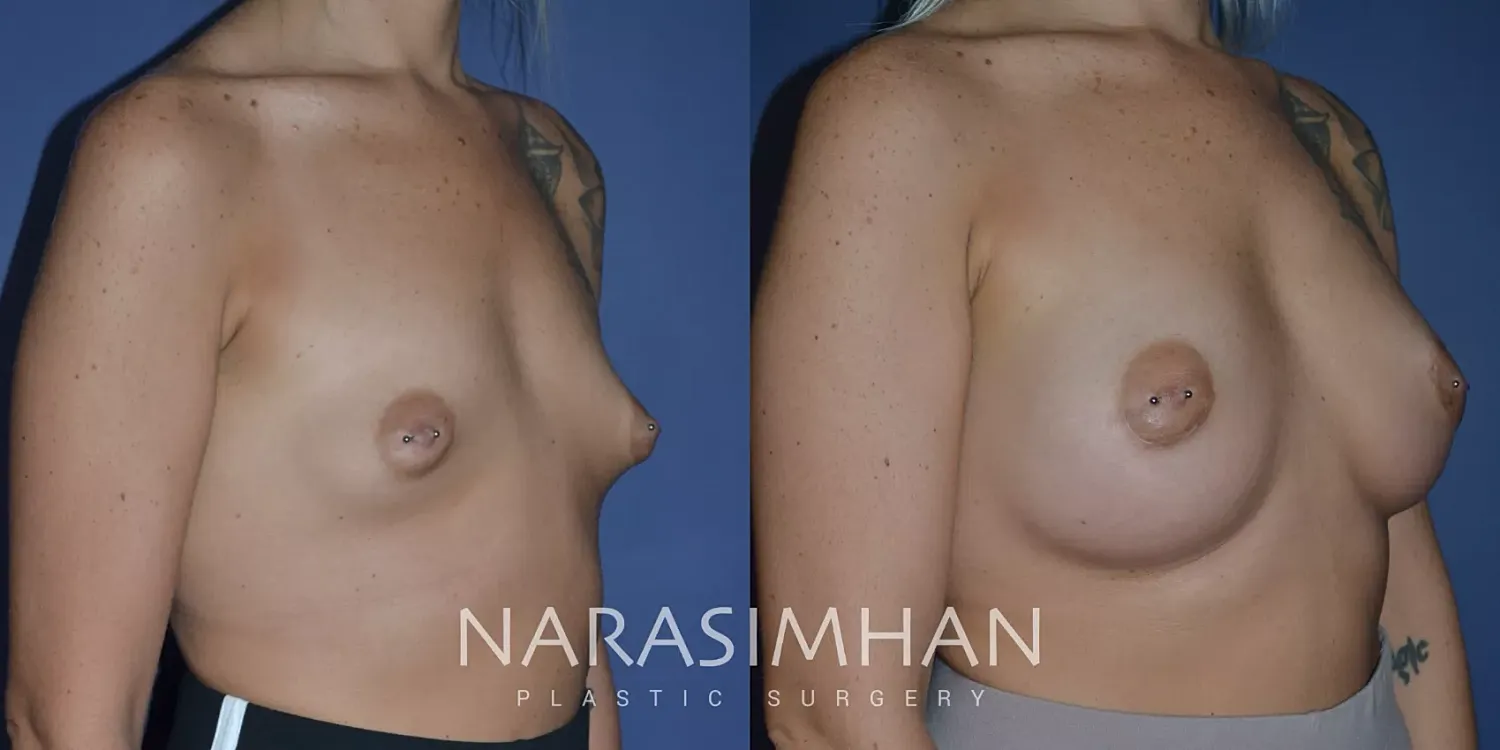 Breast Enhancement Before & After