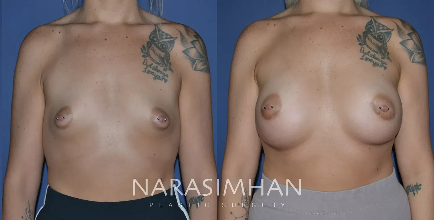 Breast Enhancement Before & After