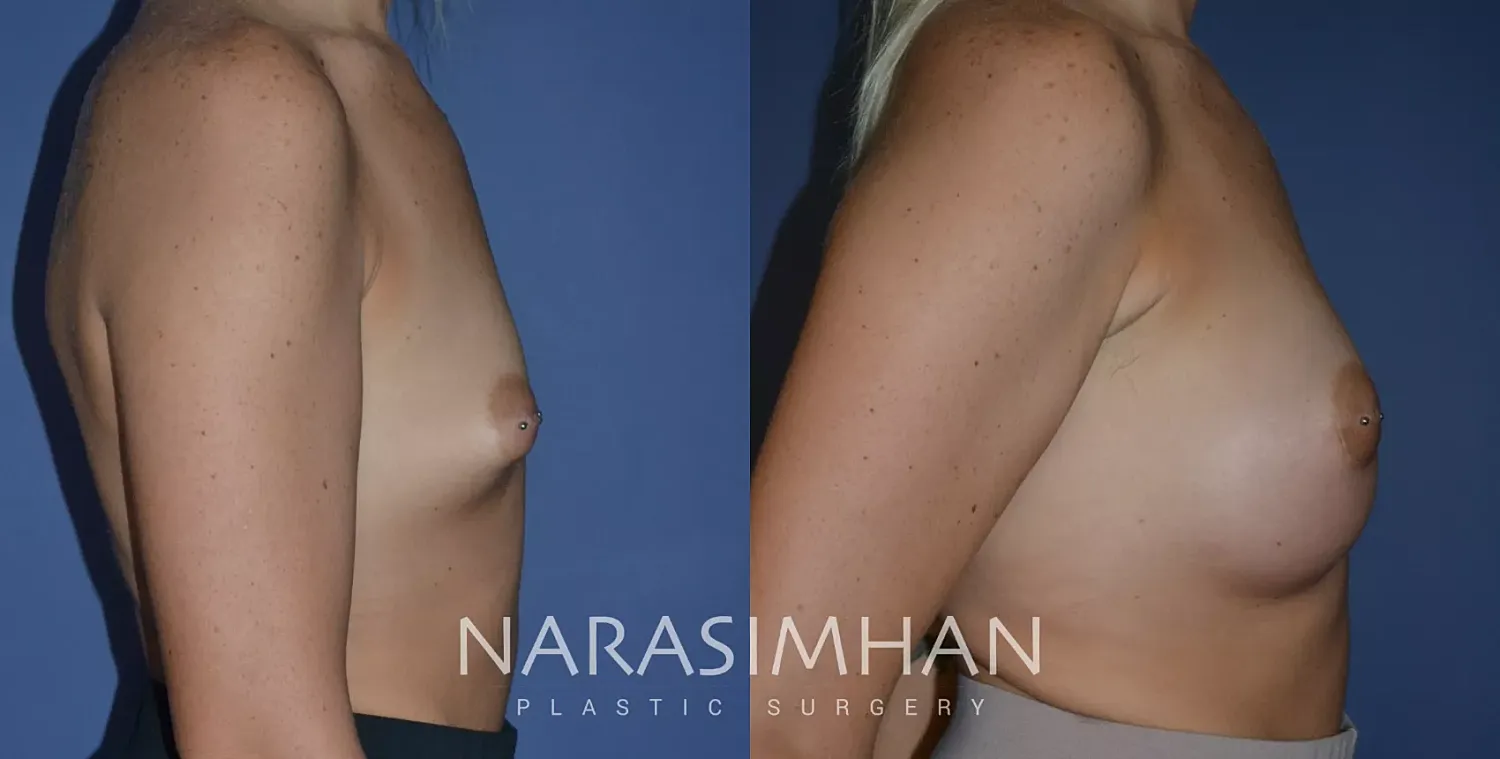 Breast Enhancement Before & After