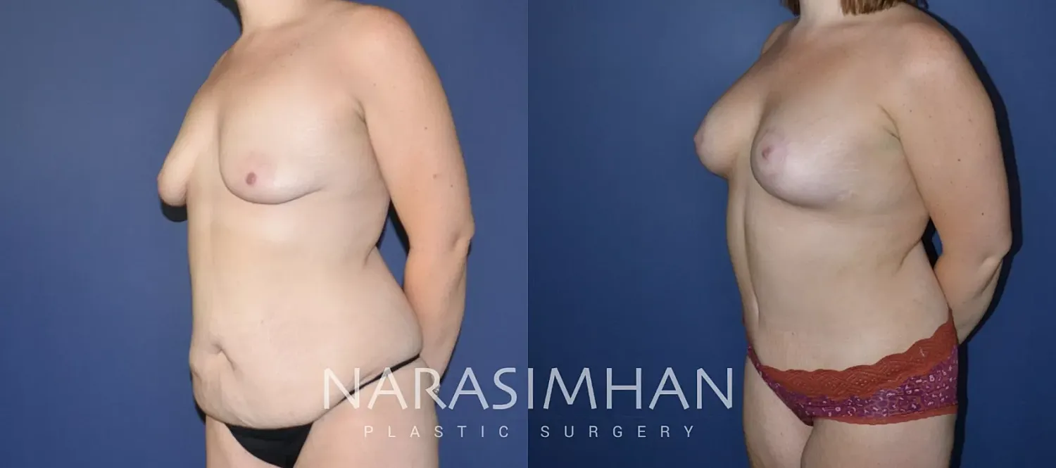 Breast Enhancement Before & After