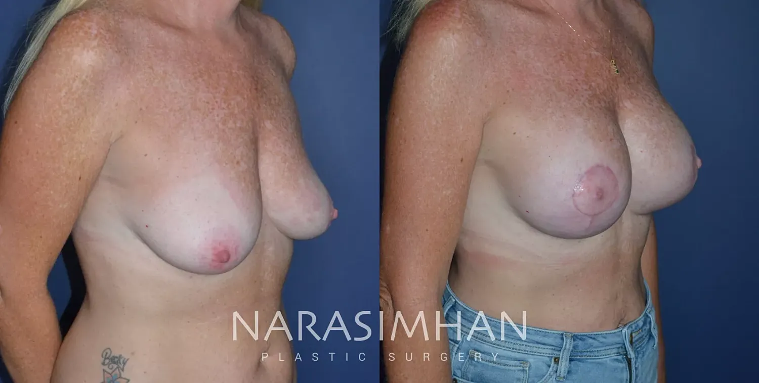 Breast Enhancement Before & After