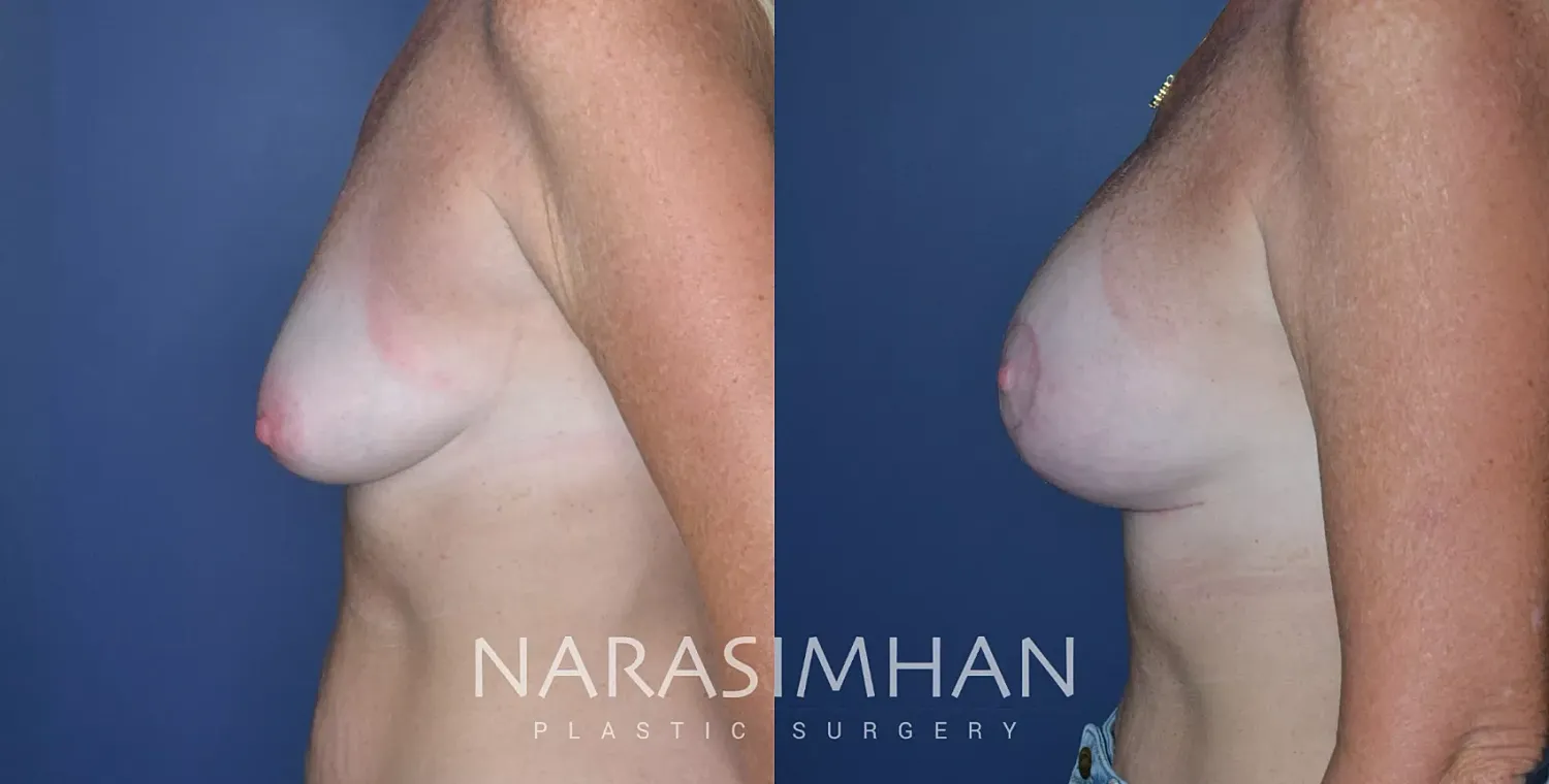 Breast Enhancement Before & After