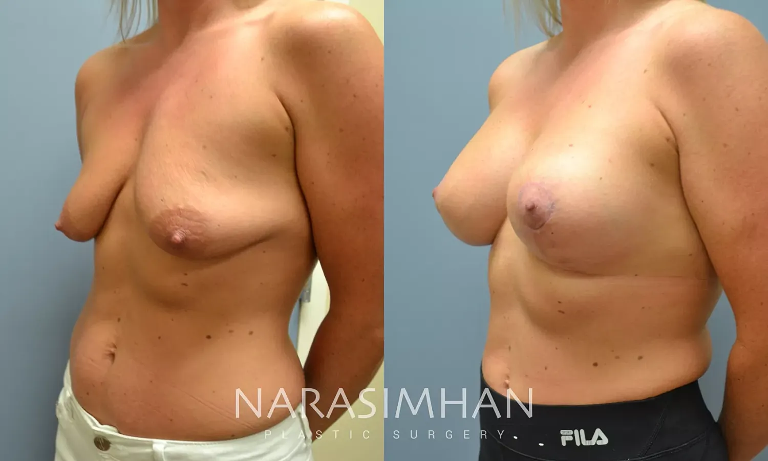 Breast Enhancement Before & After