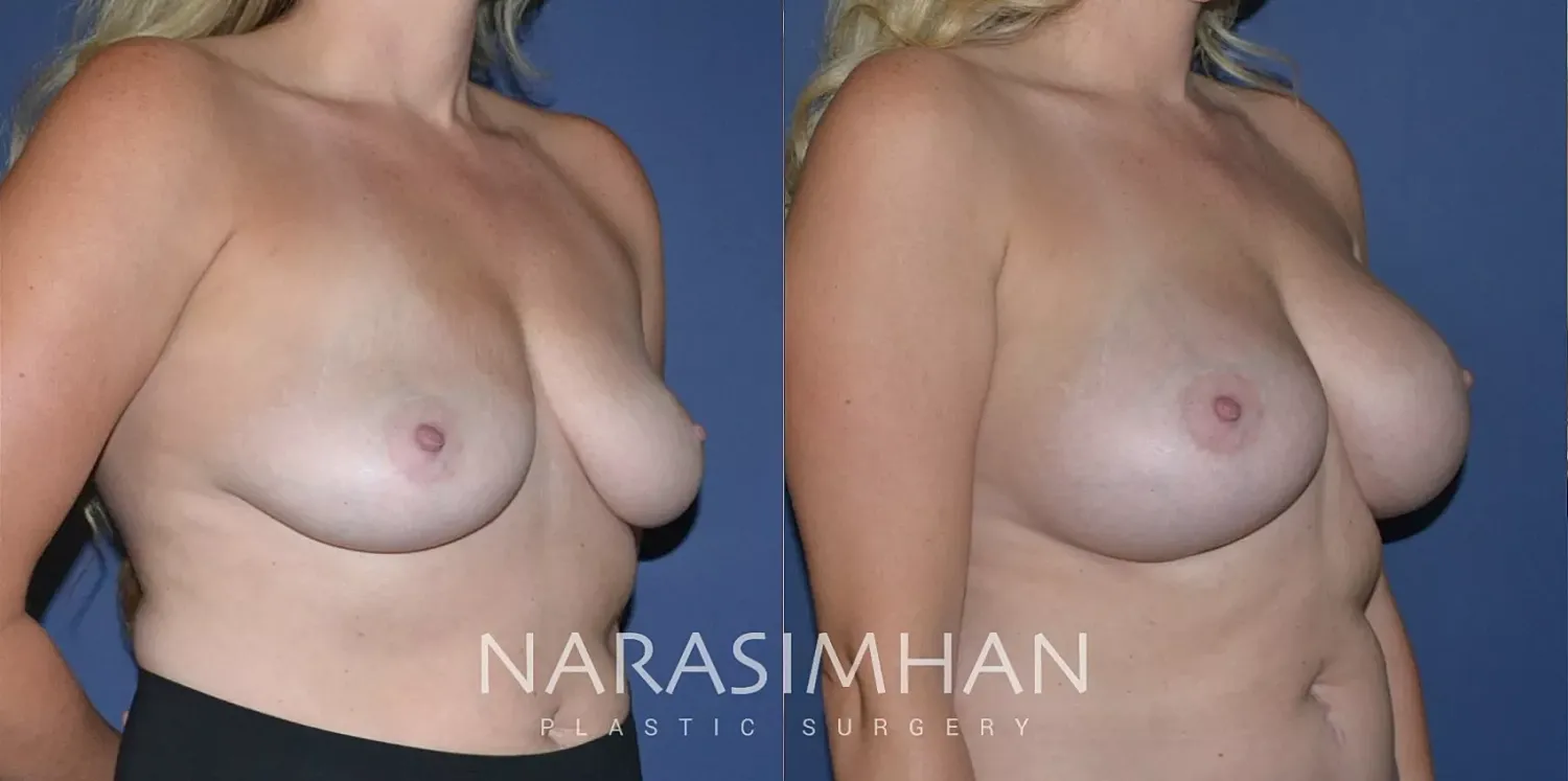 Breast Enhancement Before & After