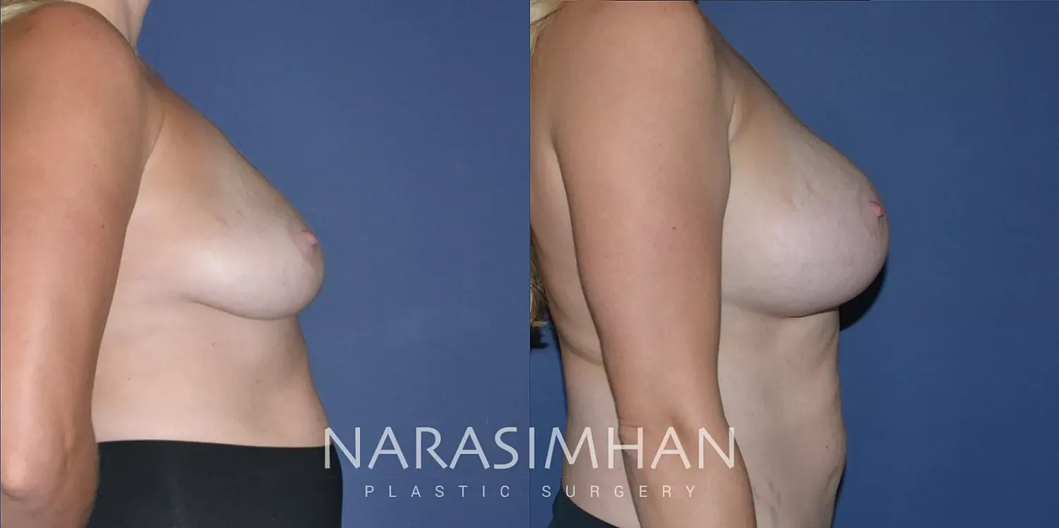 Breast Enhancement Before & After