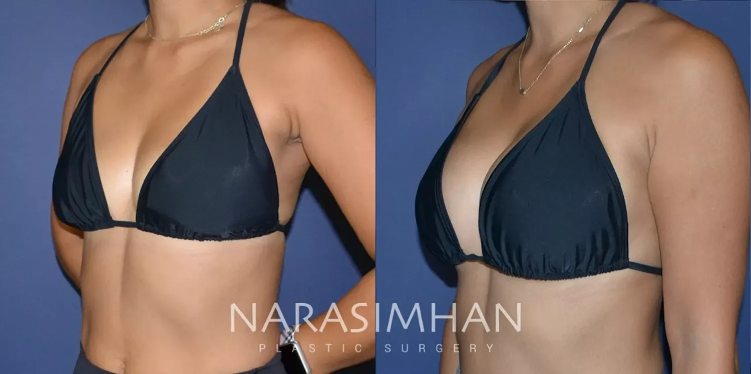 Breast Enhancement Before & After