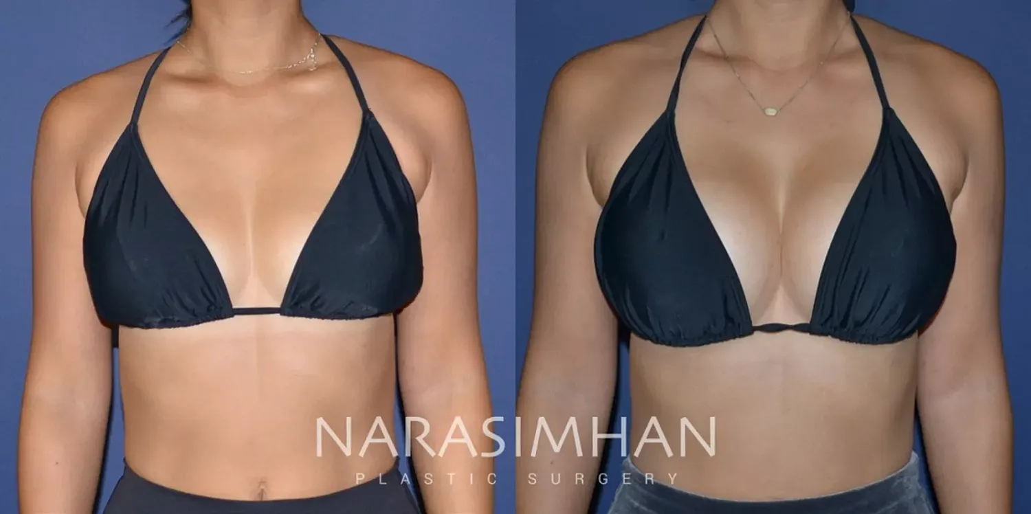 Breast Enhancement Before & After