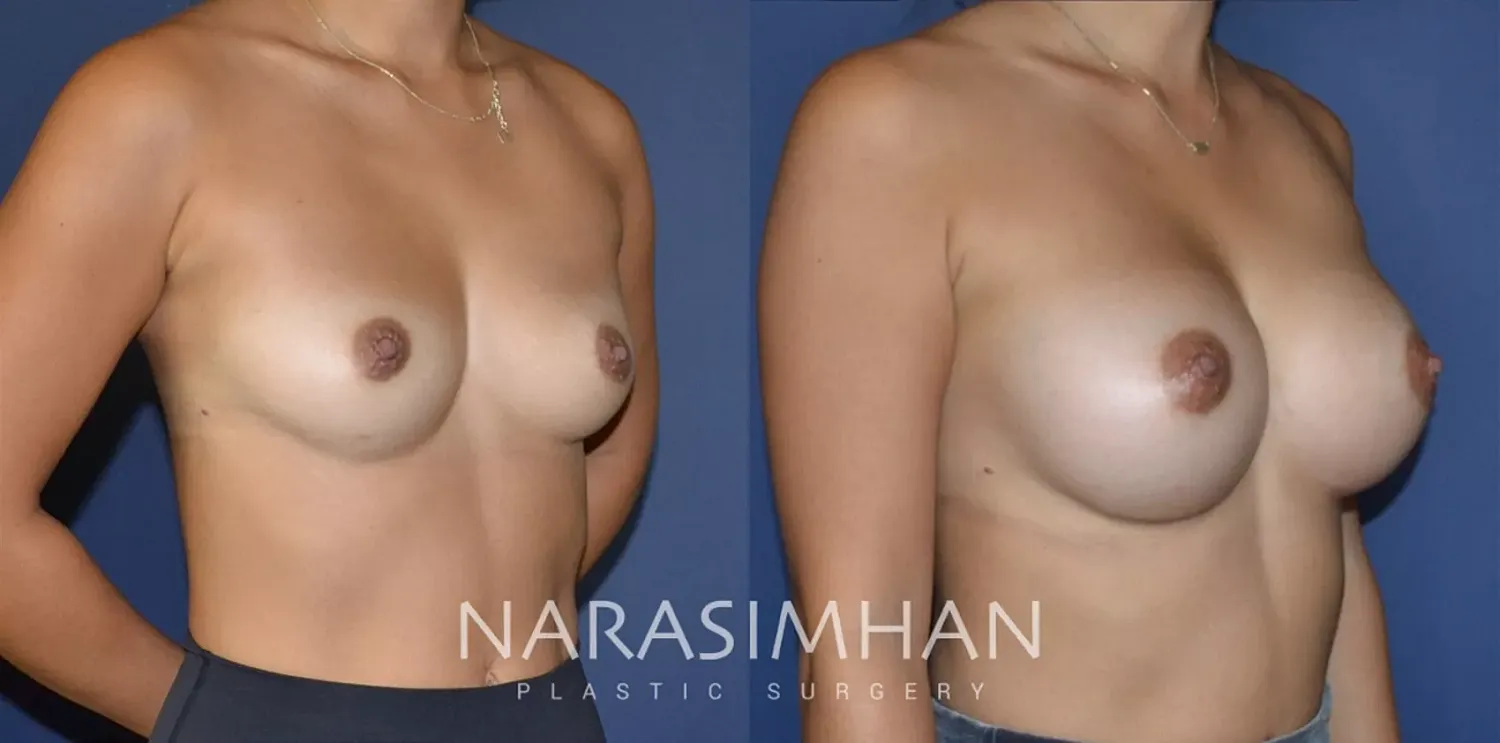 Breast Enhancement Before & After