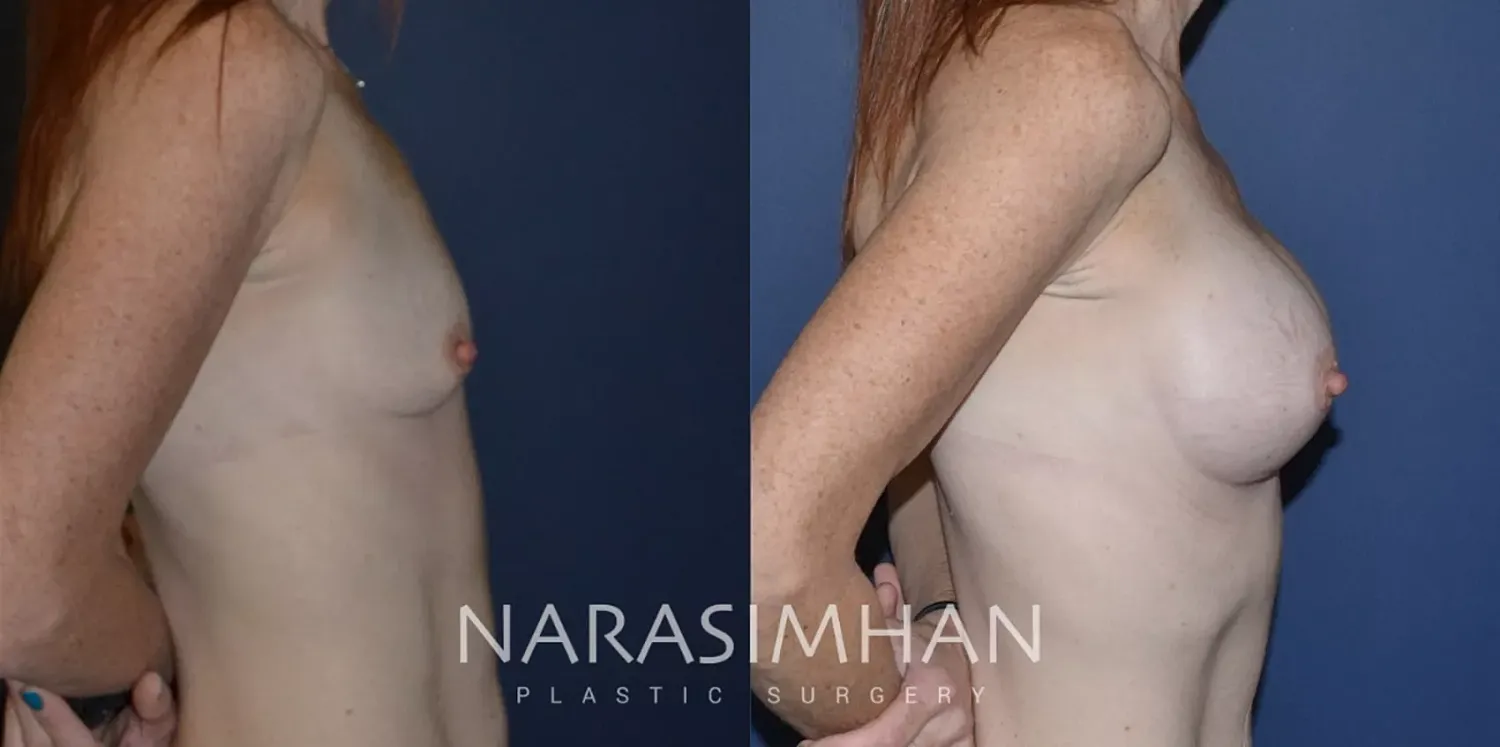Breast Enhancement Before & After