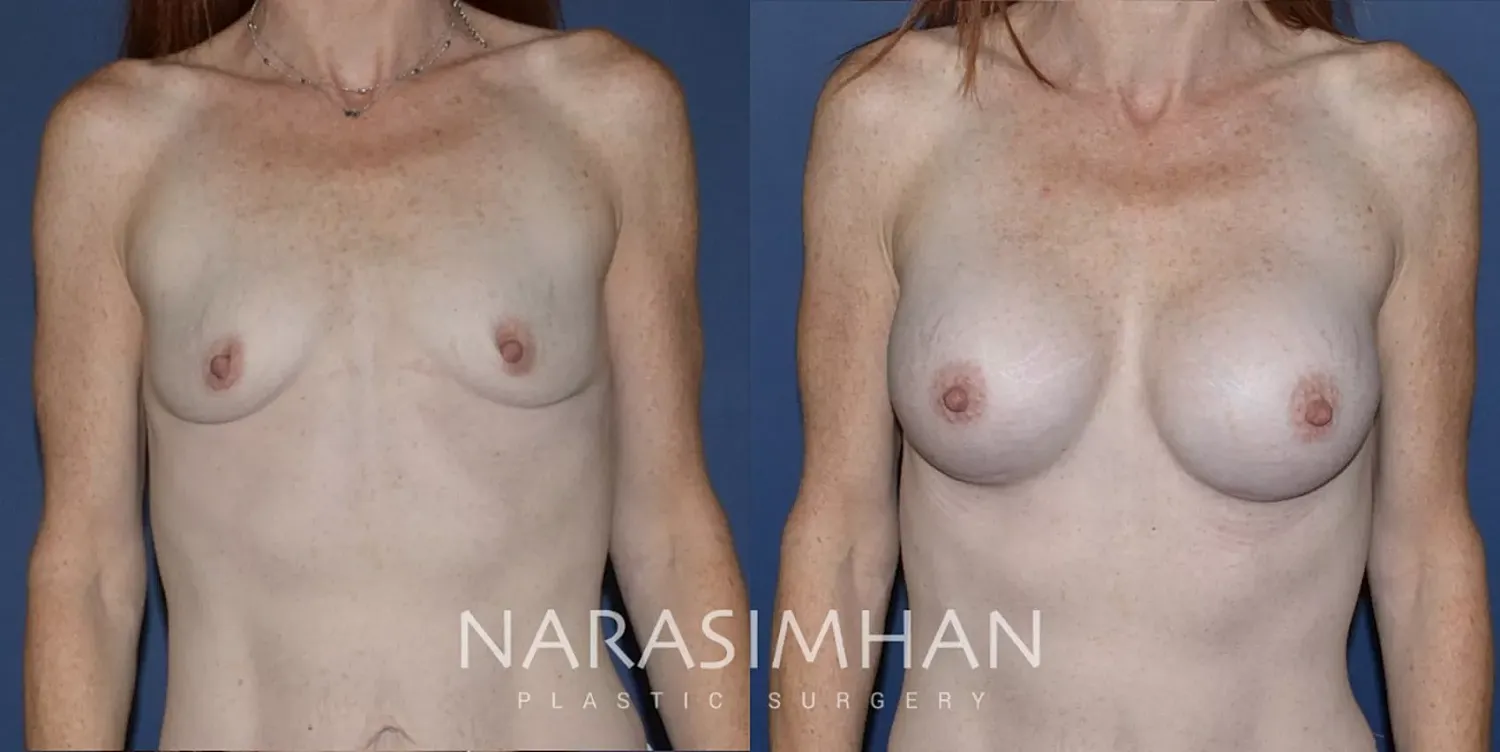 Breast Enhancement Before & After