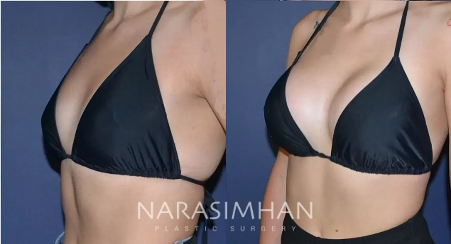Breast Enhancement Before & After