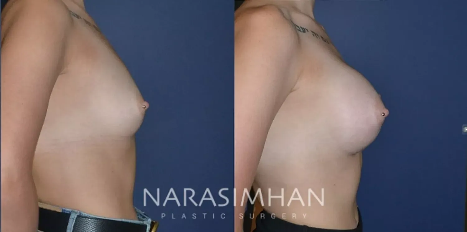 Breast Enhancement Before & After