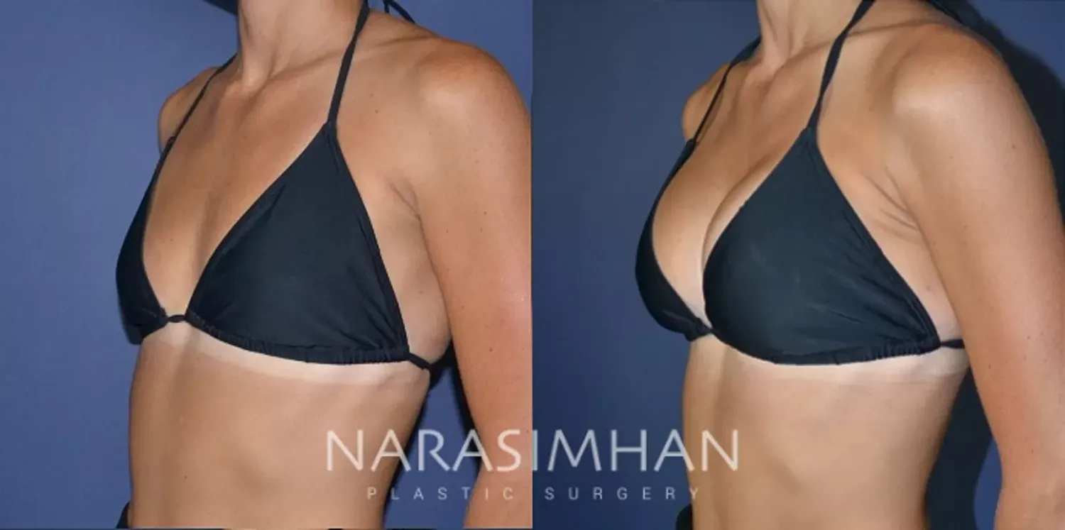 Breast Enhancement Before & After