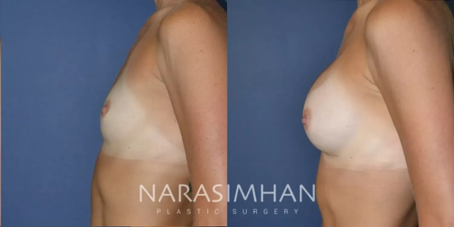 Breast Enhancement Before & After