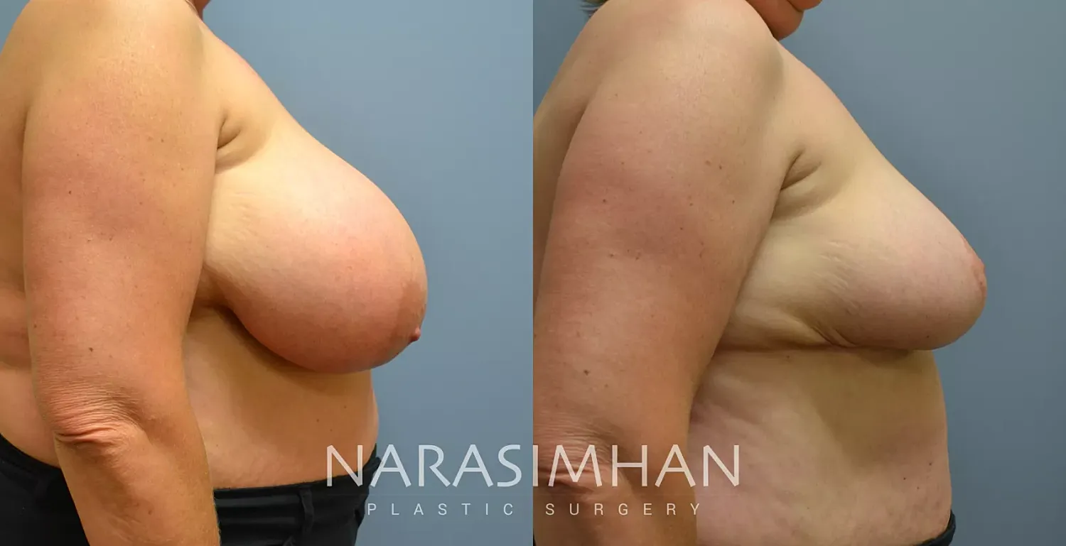 Breast Enhancement Before & After
