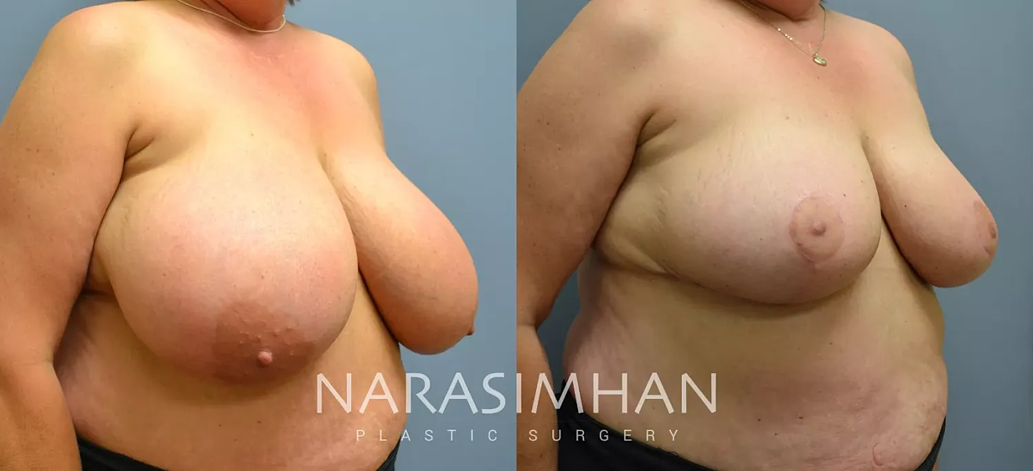 Breast Enhancement Before & After