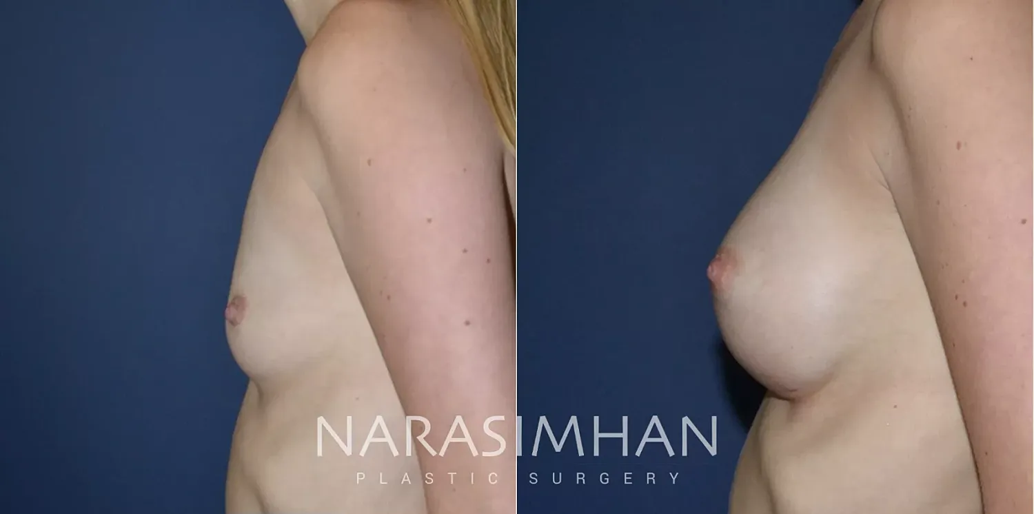 Breast Enhancement Before & After