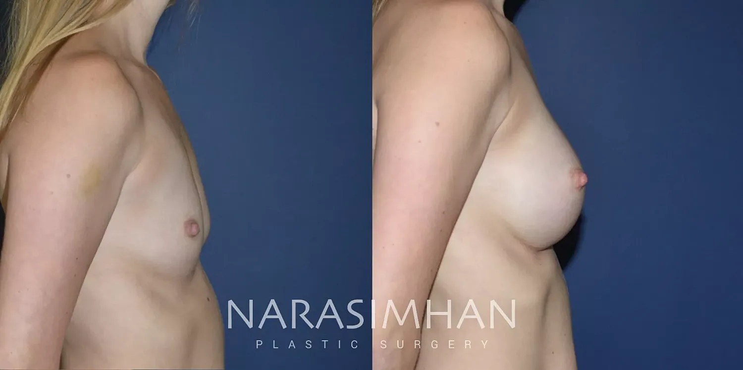 Breast Enhancement Before & After