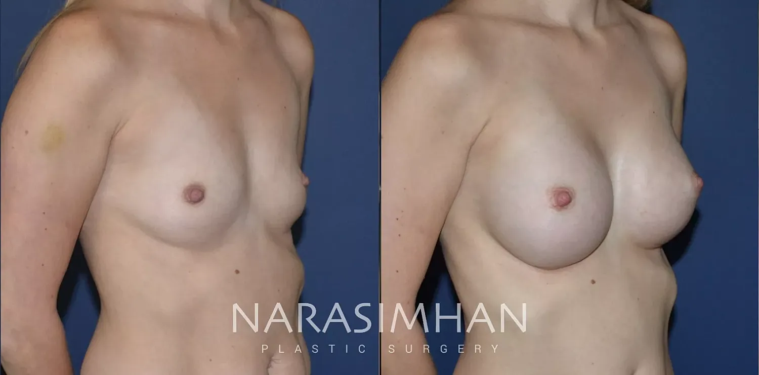 Breast Enhancement Before & After