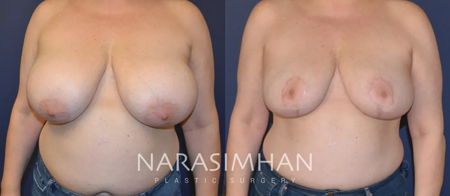 Breast Enhancement Before & After