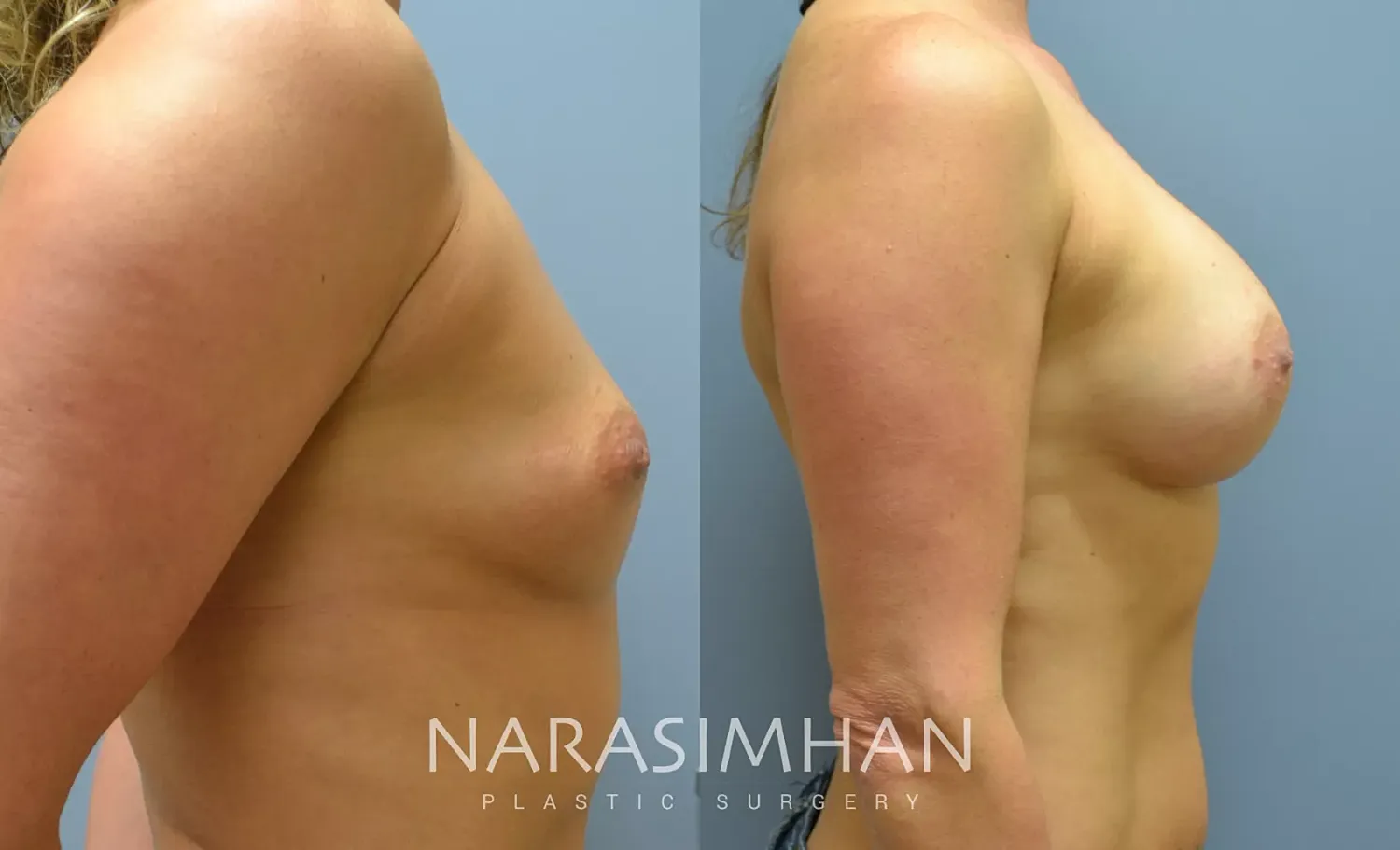 Breast Enhancement Before & After