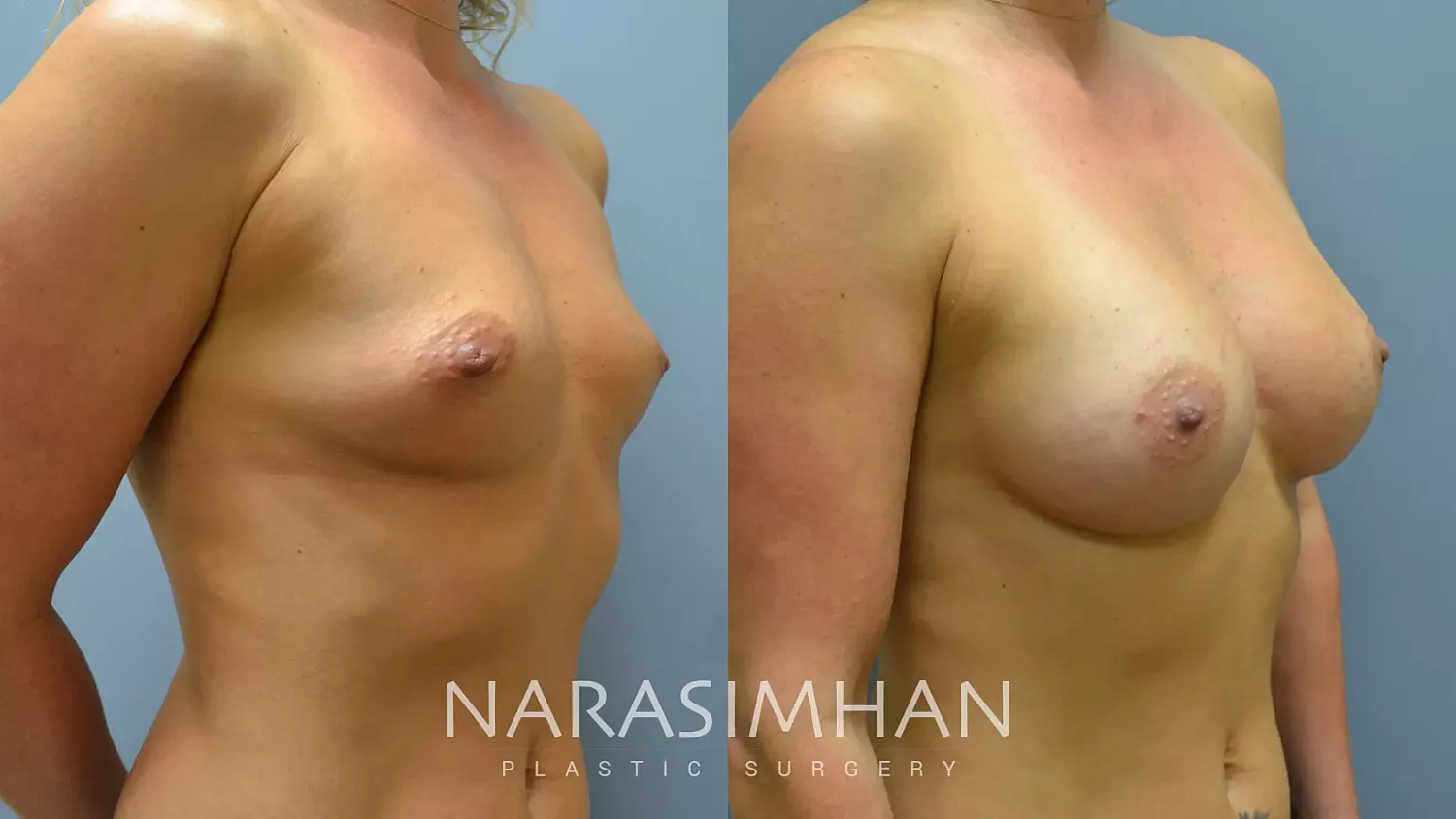 Breast Enhancement Before & After