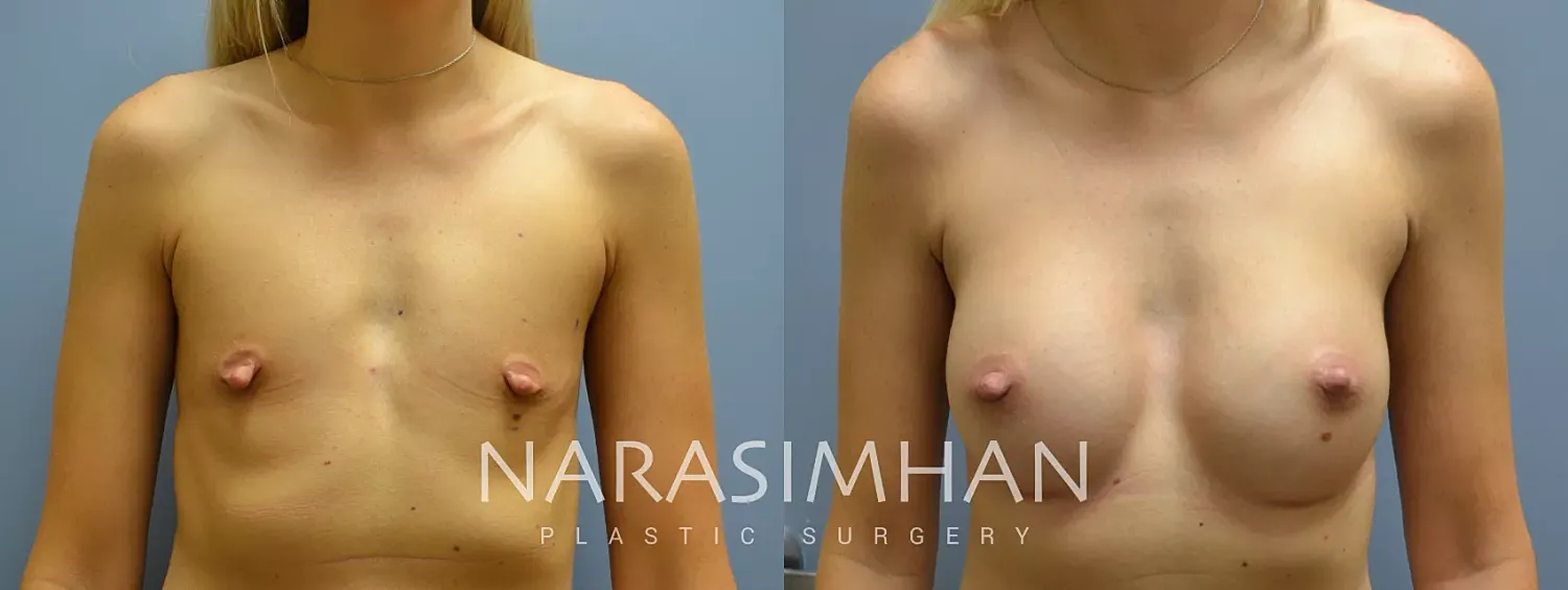 Breast Enhancement Before & After