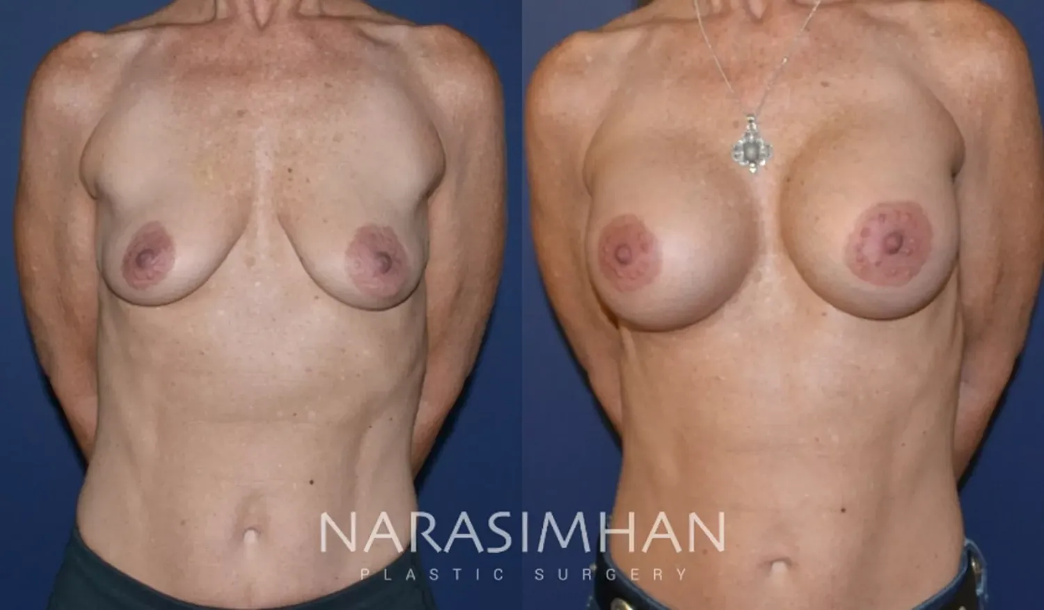 Breast Enhancement Before & After