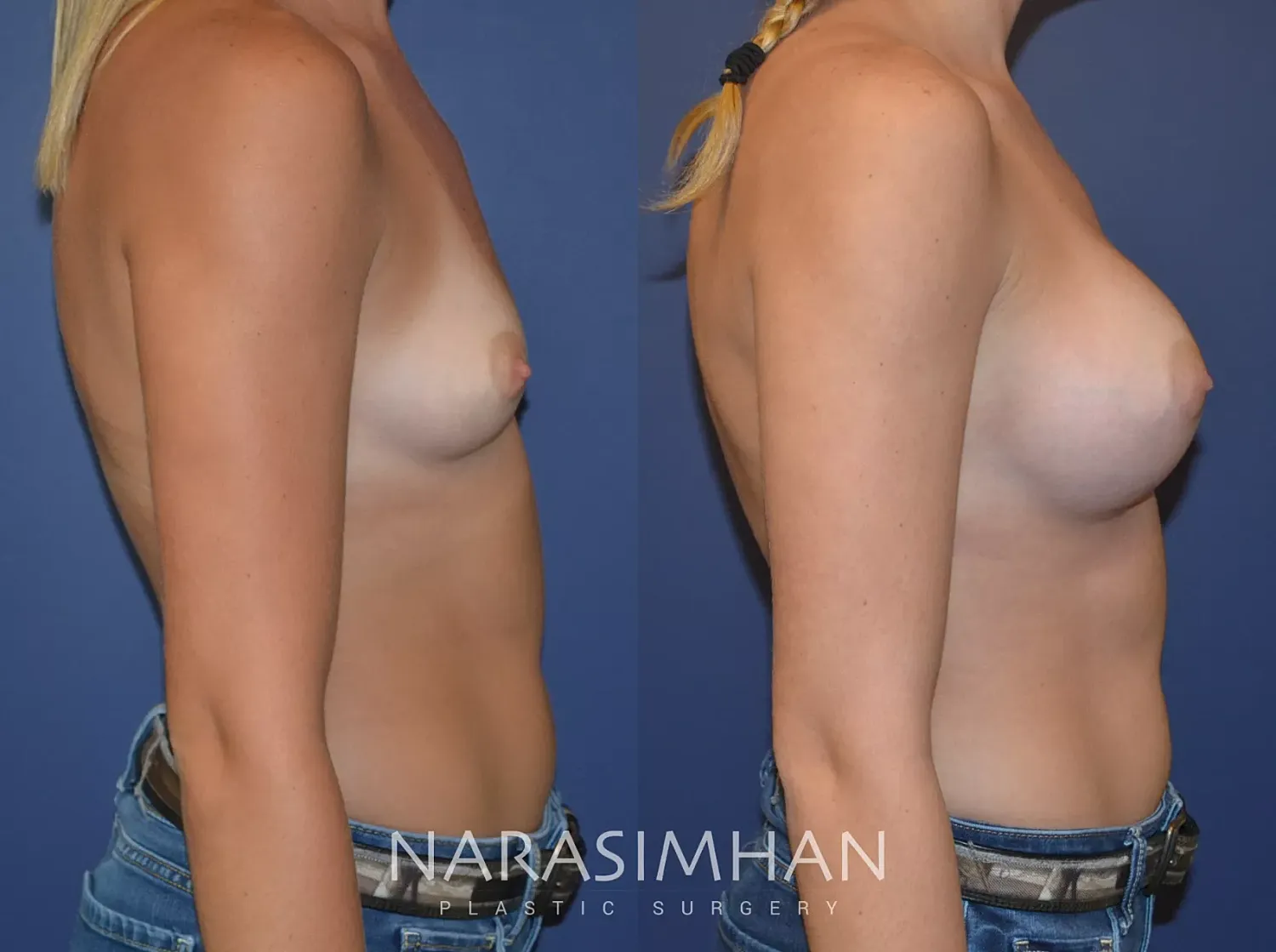 Breast Enhancement Before & After