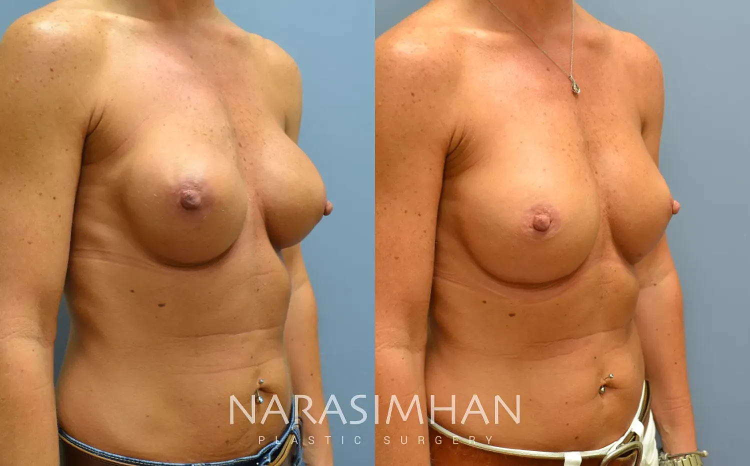 Breast Enhancement Before & After