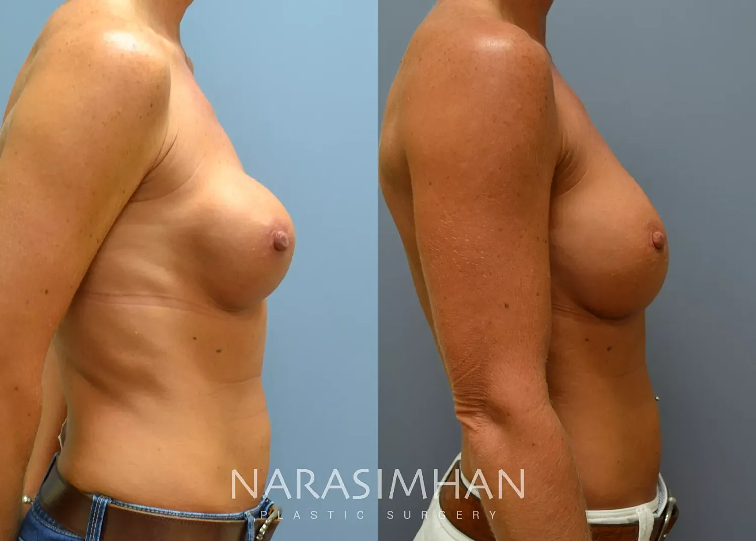 Breast Enhancement Before & After