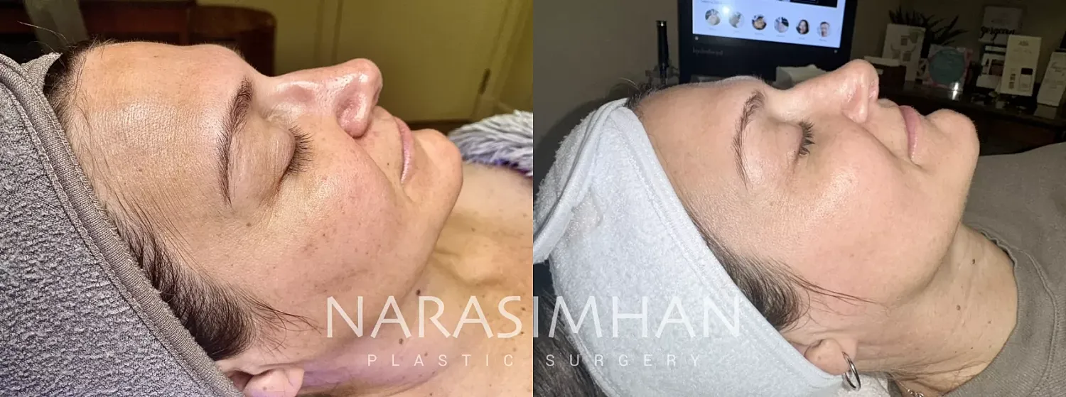 Bbl Moxi Before & After