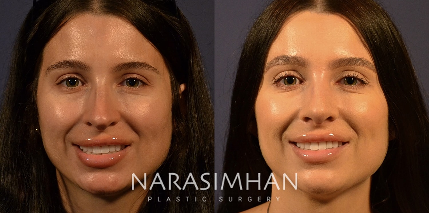 Facial Sculpting Before & After