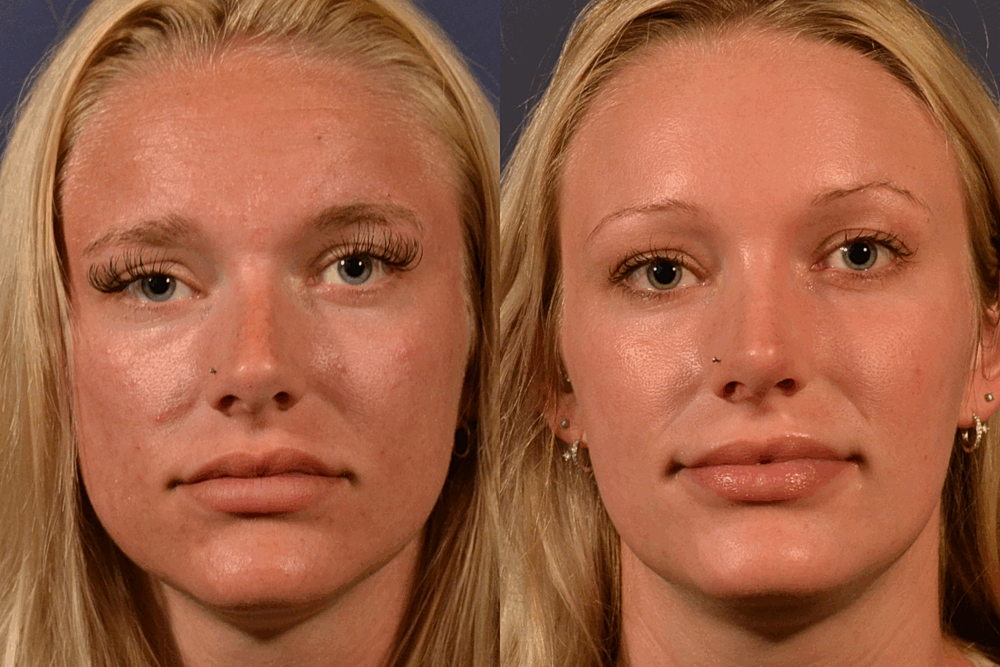 Facial Sculpting Before & After