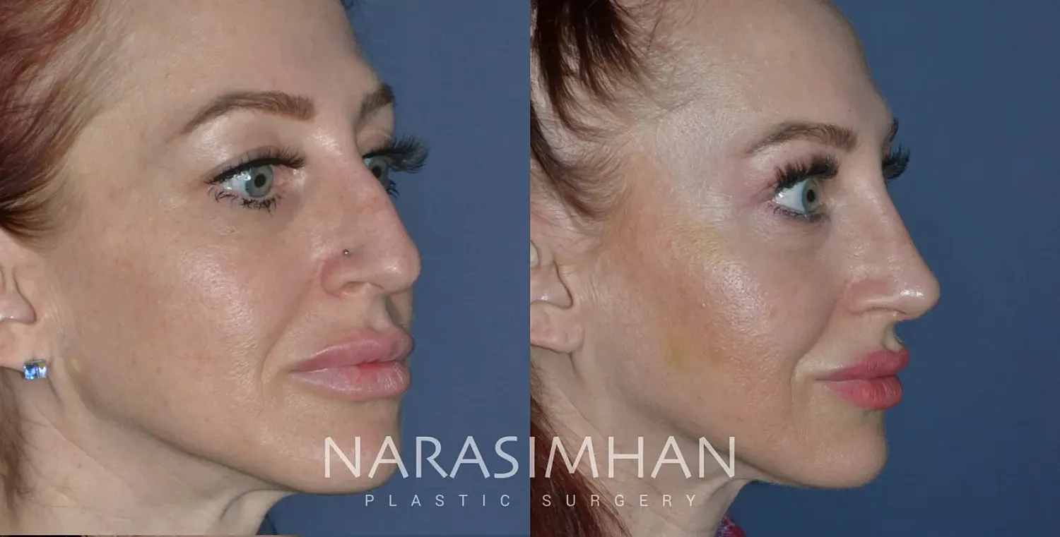 Facial Sculpting Before & After