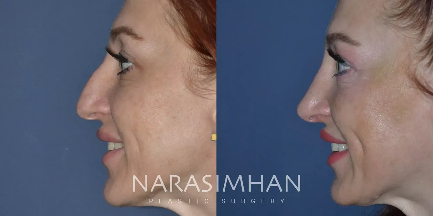 Facial Sculpting Before & After