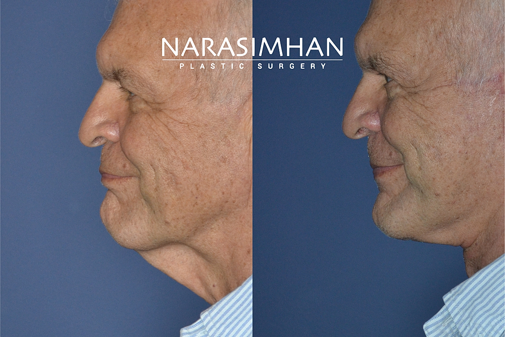 Facial Sculpting Before & After