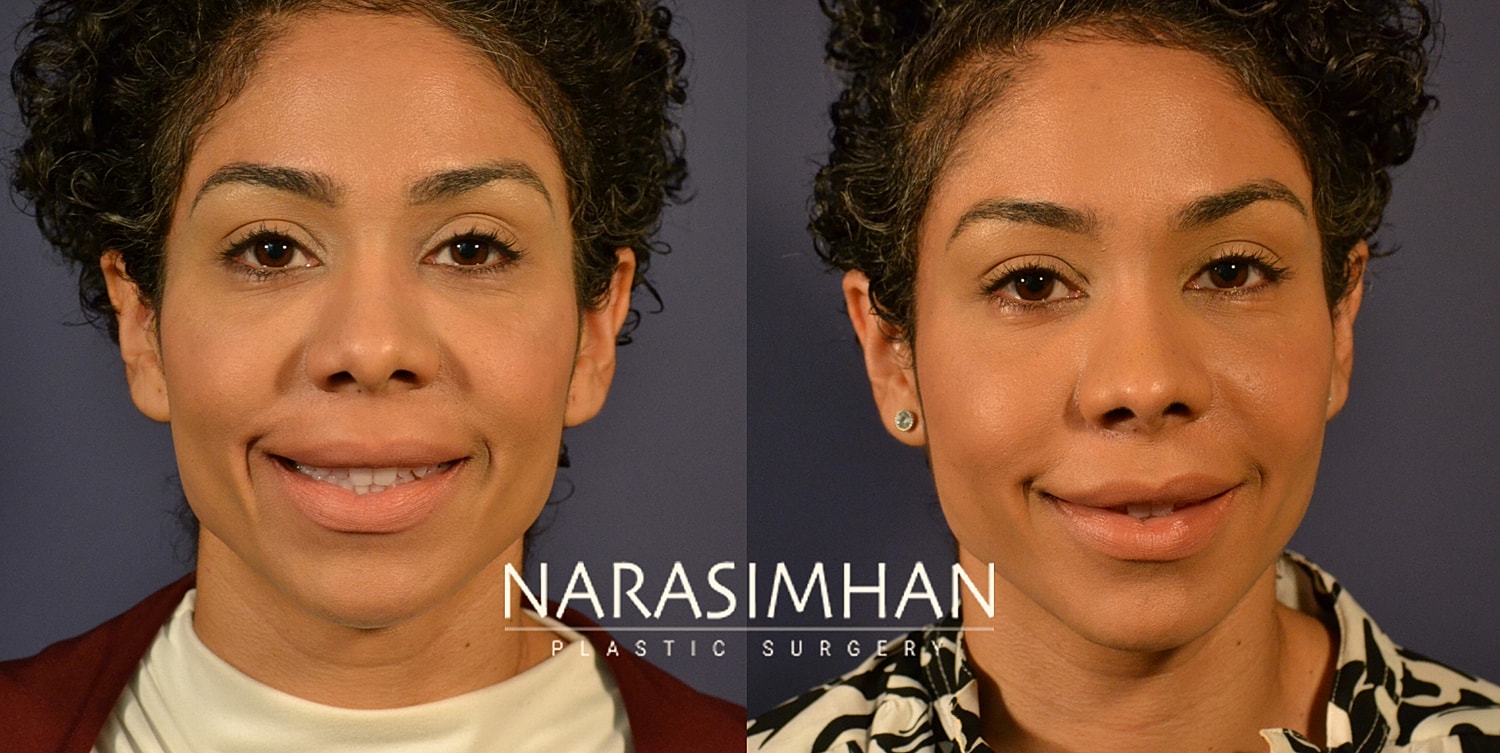 Facial Sculpting Before & After