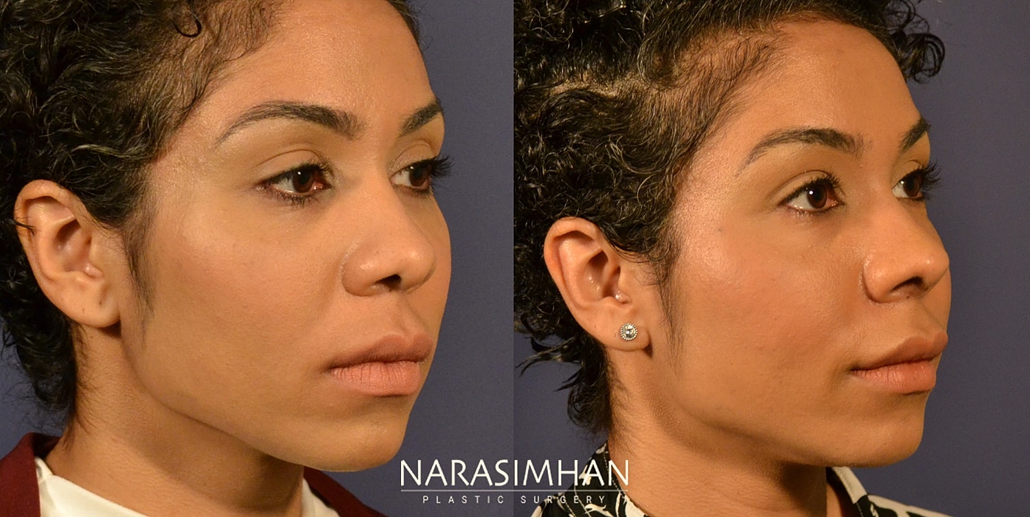Facial Sculpting Before & After