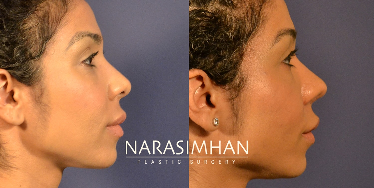 Facial Sculpting Before & After
