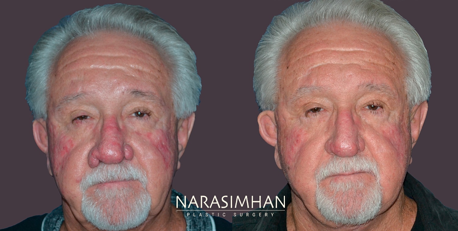 Facial Sculpting Before & After