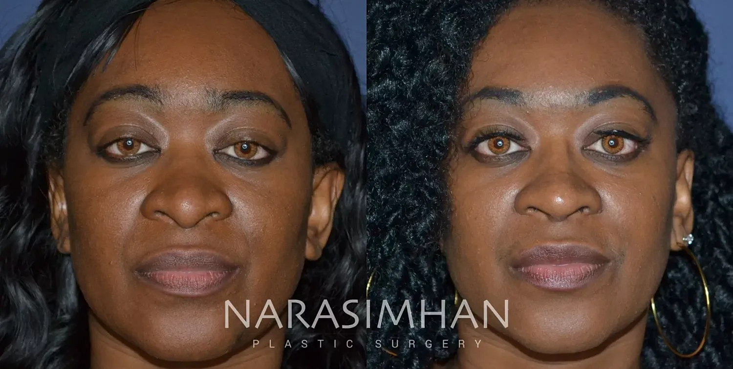Facial Sculpting Before & After