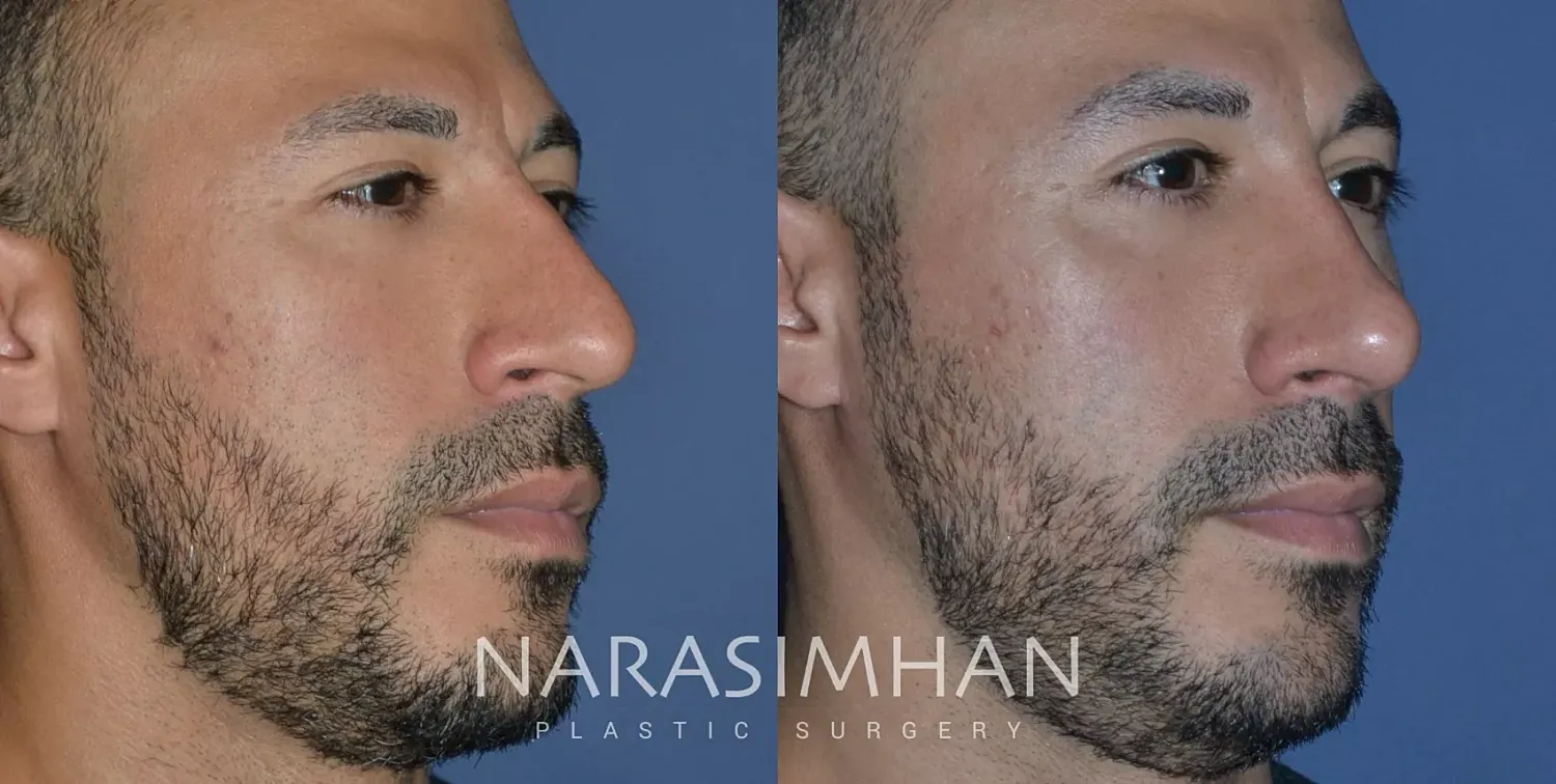 Facial Sculpting Before & After