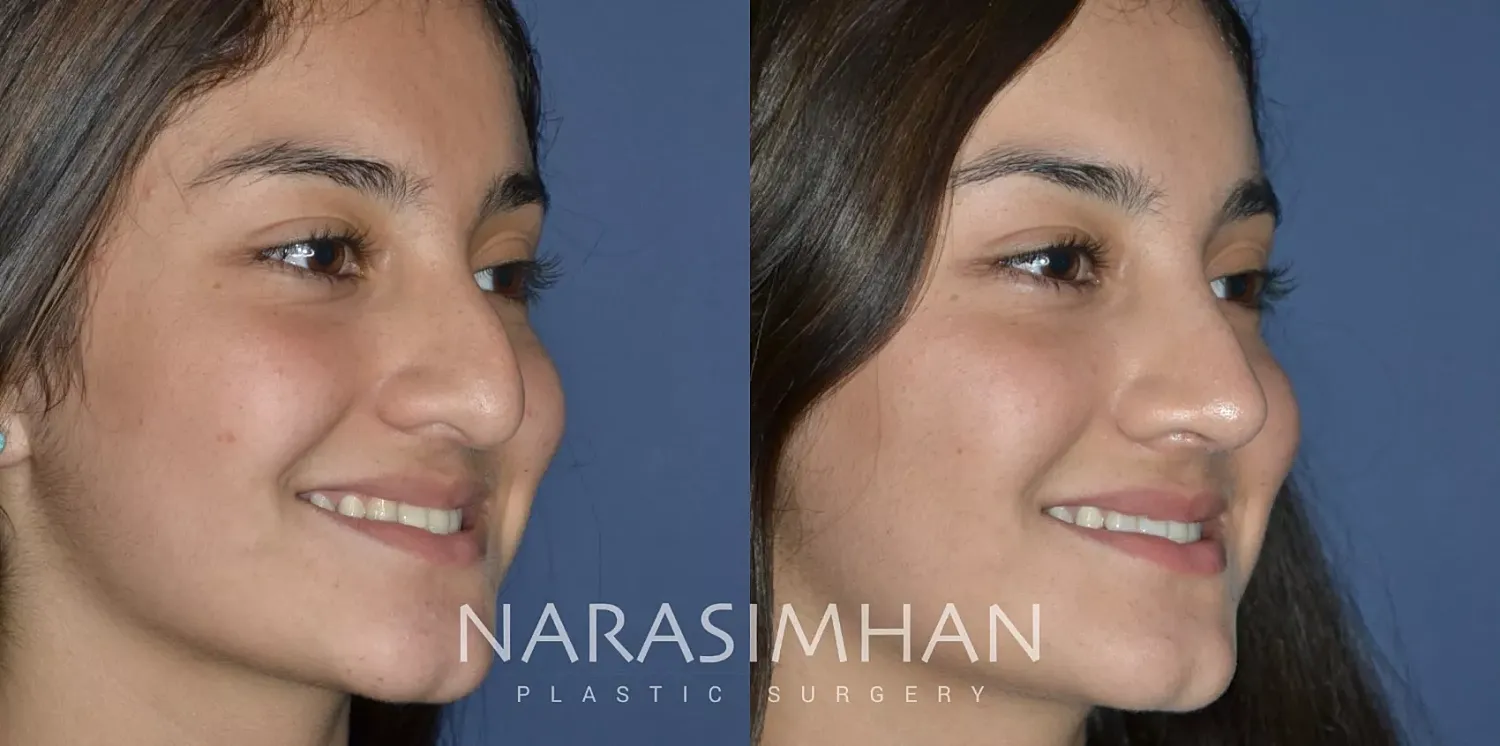 Facial Sculpting Before & After