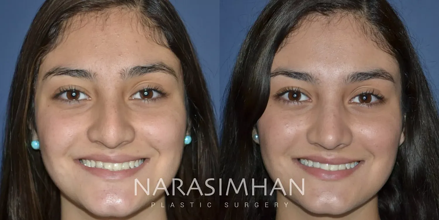 Facial Sculpting Before & After