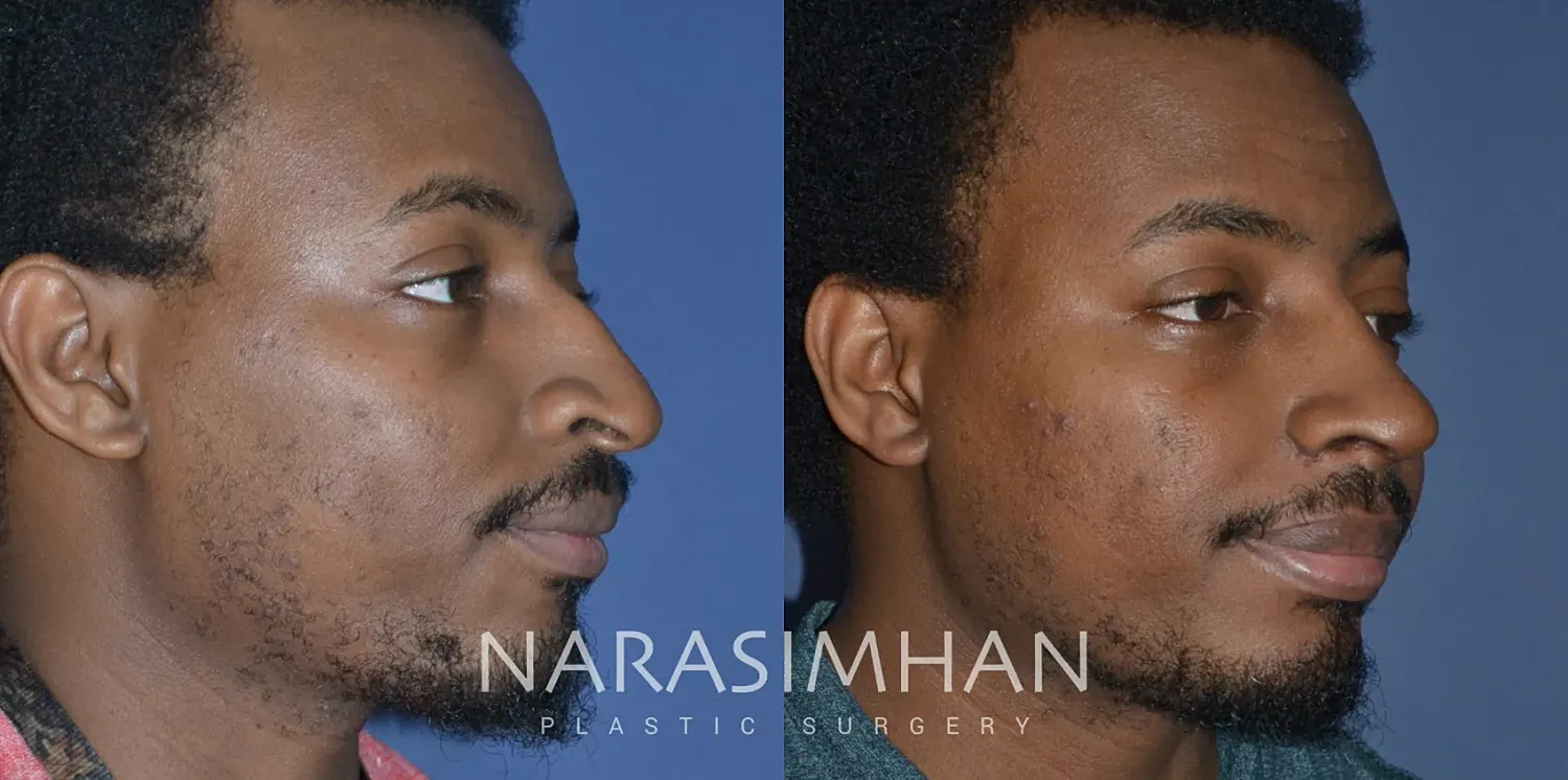 Facial Sculpting Before & After