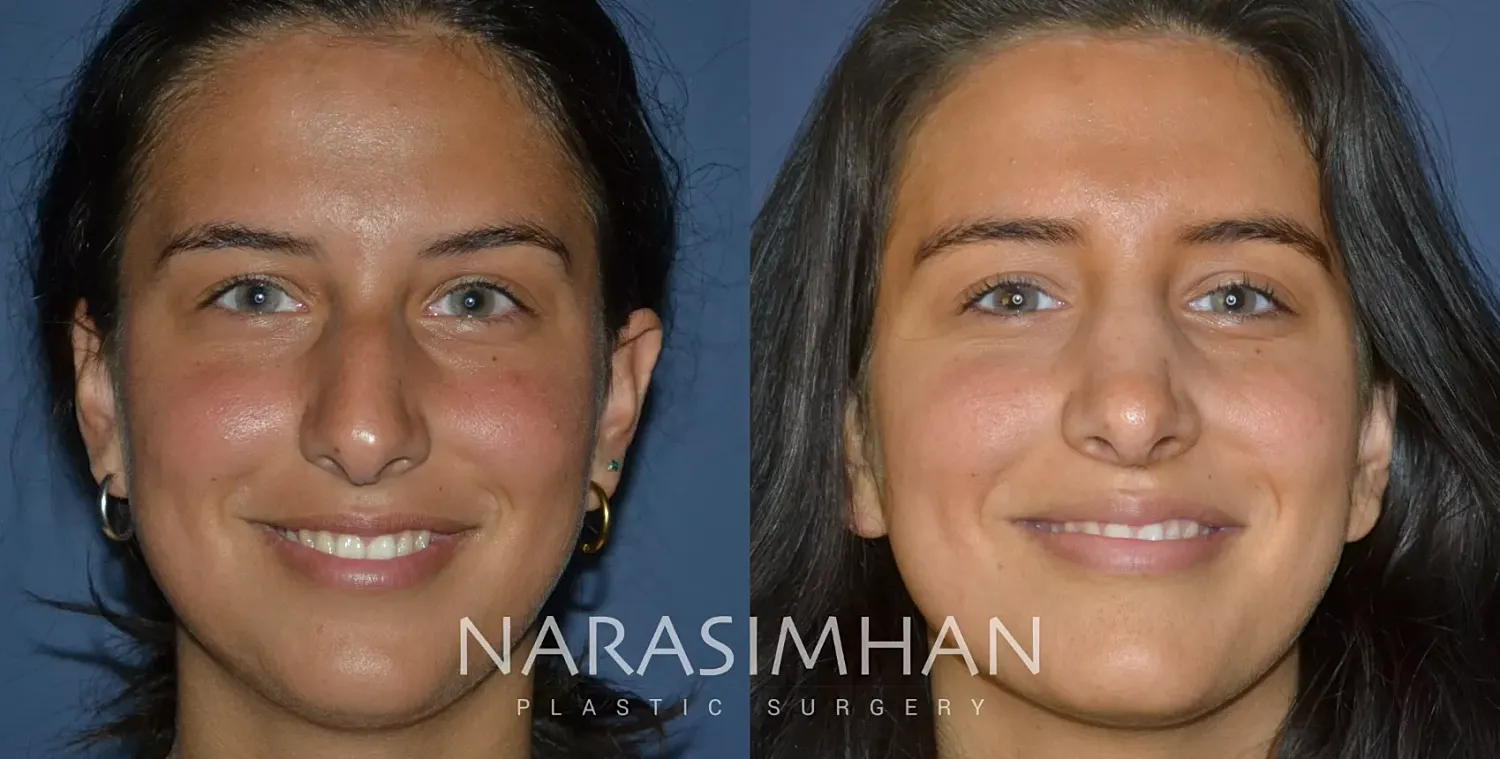 Facial Sculpting Before & After