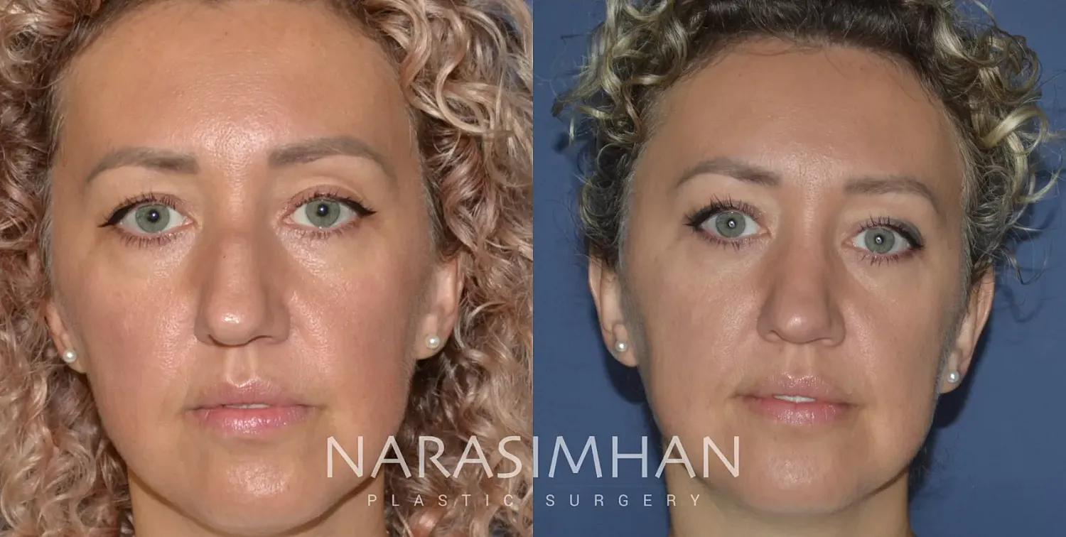 Facial Sculpting Before & After