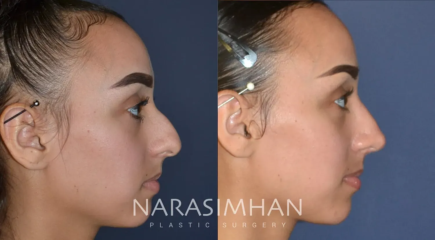 Facial Sculpting Before & After